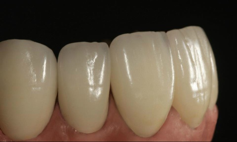 Porcelain fused metal dental crown cocr precious