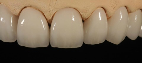 Porcelain fused metal dental crown semi precious