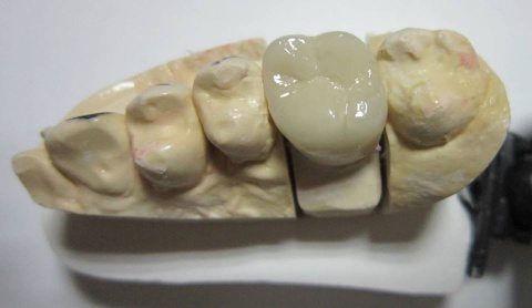 Porcelain fused metal dental crown Titanium precious